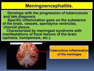 Comprehensive Overview of Tuberculous Meningitis: Diagnosis, Clinical ...