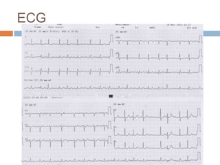 ECG
 