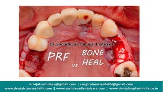 Platelet rich fibrin | Dental Implants with PRF | PRF In regenerative ...