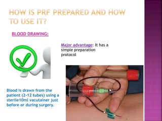 PLATELET RICH FIBRIN - ROLE IN PERIODONTICS | PPTX