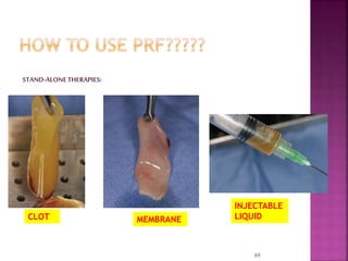 PLATELET RICH FIBRIN - ROLE IN PERIODONTICS | PPTX