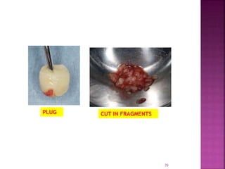 PLATELET RICH FIBRIN - ROLE IN PERIODONTICS | PPTX