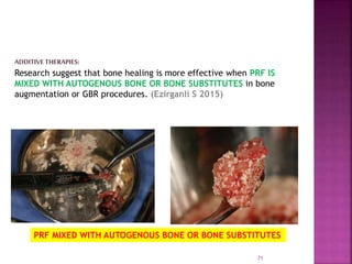 PLATELET RICH FIBRIN - ROLE IN PERIODONTICS | PPTX