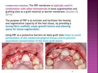 PLATELET RICH FIBRIN - ROLE IN PERIODONTICS | PPTX