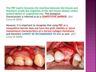 PLATELET RICH FIBRIN - ROLE IN PERIODONTICS | PPTX