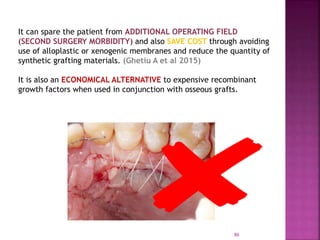 PLATELET RICH FIBRIN - ROLE IN PERIODONTICS | PPTX
