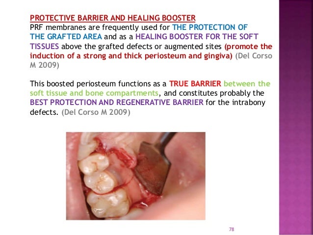 Platelet Rich Fibrin Role In Periodontics - 