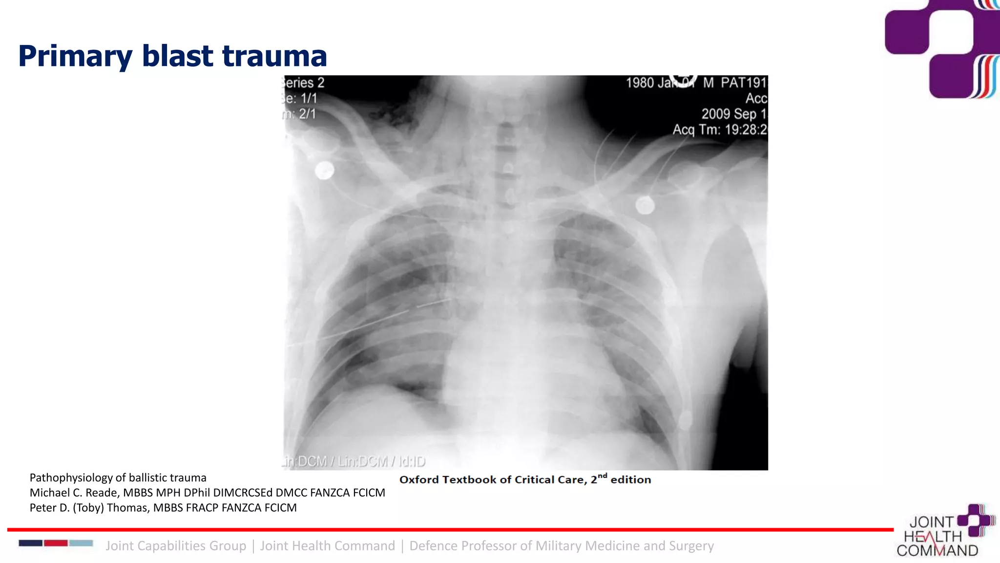 Pathophysiology of ballistic trauma
Michael C. Reade, MBBS MPH DPhil DIMCRCSEd DMCC FANZCA FCICM
Peter D. (Toby) Thomas, MBBS FRACP FANZCA FCICM
Joint Capabilities Group │ Joint Health Command │ Defence Professor of Military Medicine and Surgery
Primary blast trauma
 