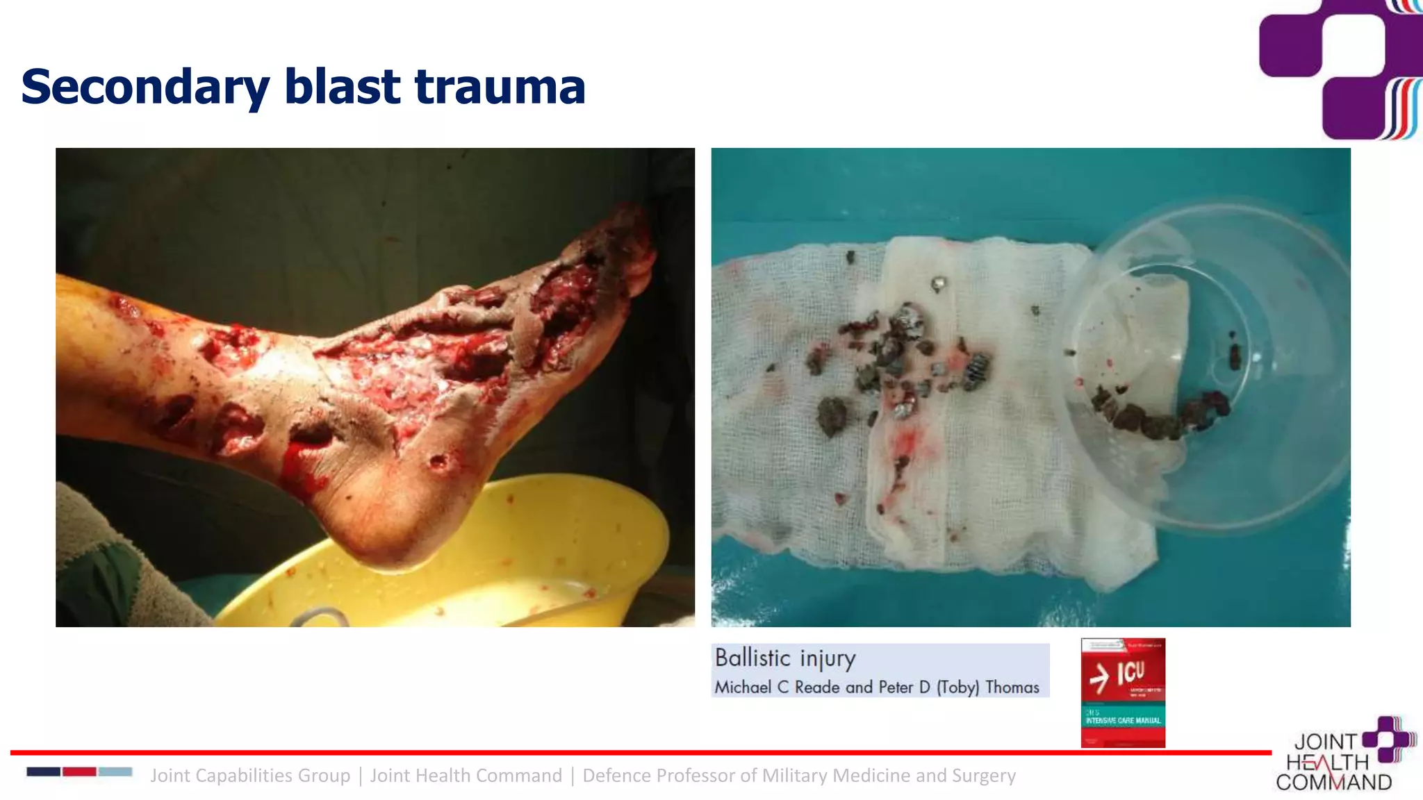 Secondary blast trauma
Joint Capabilities Group │ Joint Health Command │ Defence Professor of Military Medicine and Surgery
 