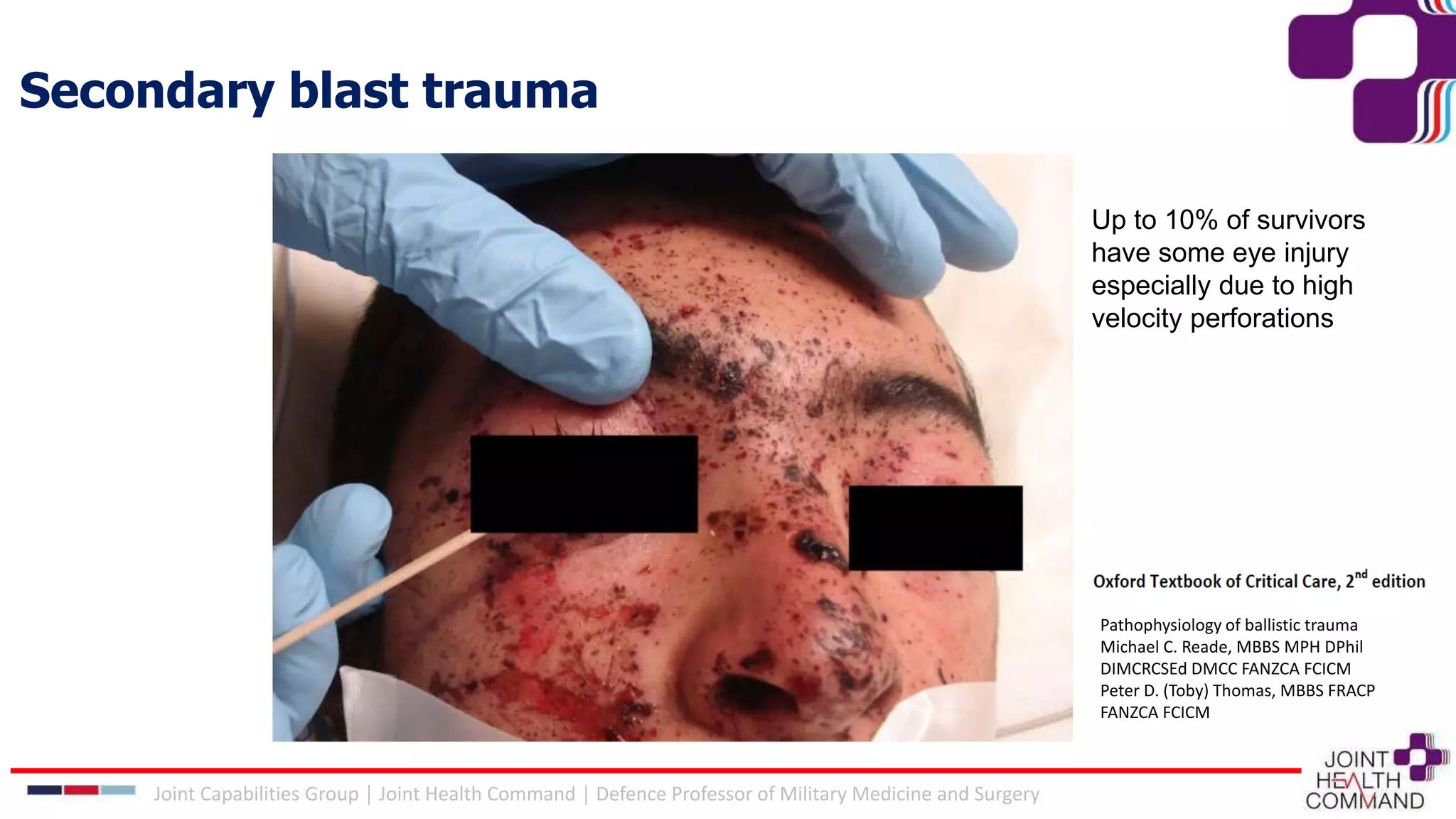 Secondary blast trauma
Ballistic trauma in blast injury
Pathophysiology of ballistic trauma
Michael C. Reade, MBBS MPH DPhil
DIMCRCSEd DMCC FANZCA FCICM
Peter D. (Toby) Thomas, MBBS FRACP
FANZCA FCICM
Joint Capabilities Group │ Joint Health Command │ Defence Professor of Military Medicine and Surgery
Up to 10% of survivors
have some eye injury
especially due to high
velocity perforations
 