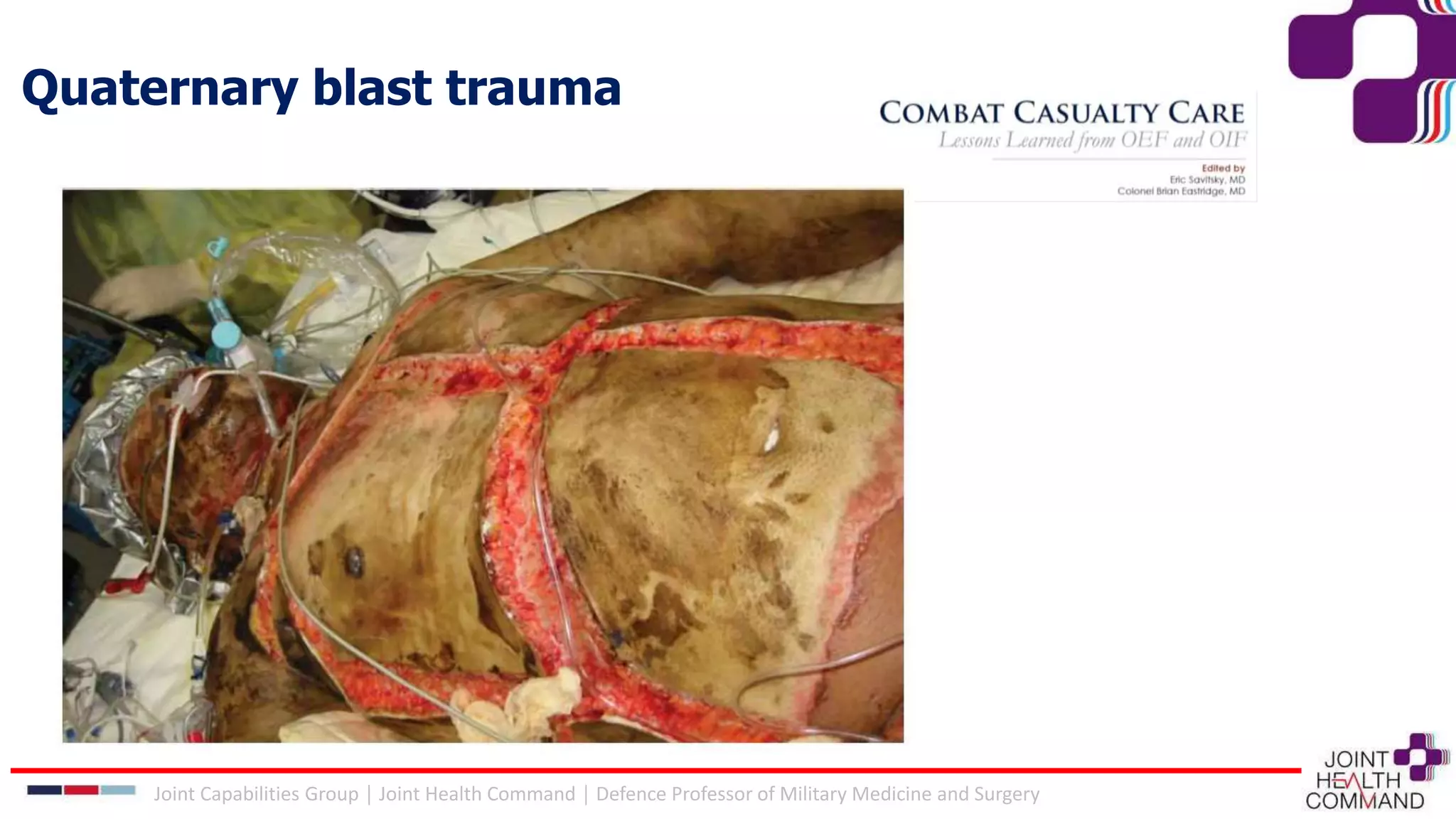 Quaternary blast trauma
Joint Capabilities Group │ Joint Health Command │ Defence Professor of Military Medicine and Surgery
 
