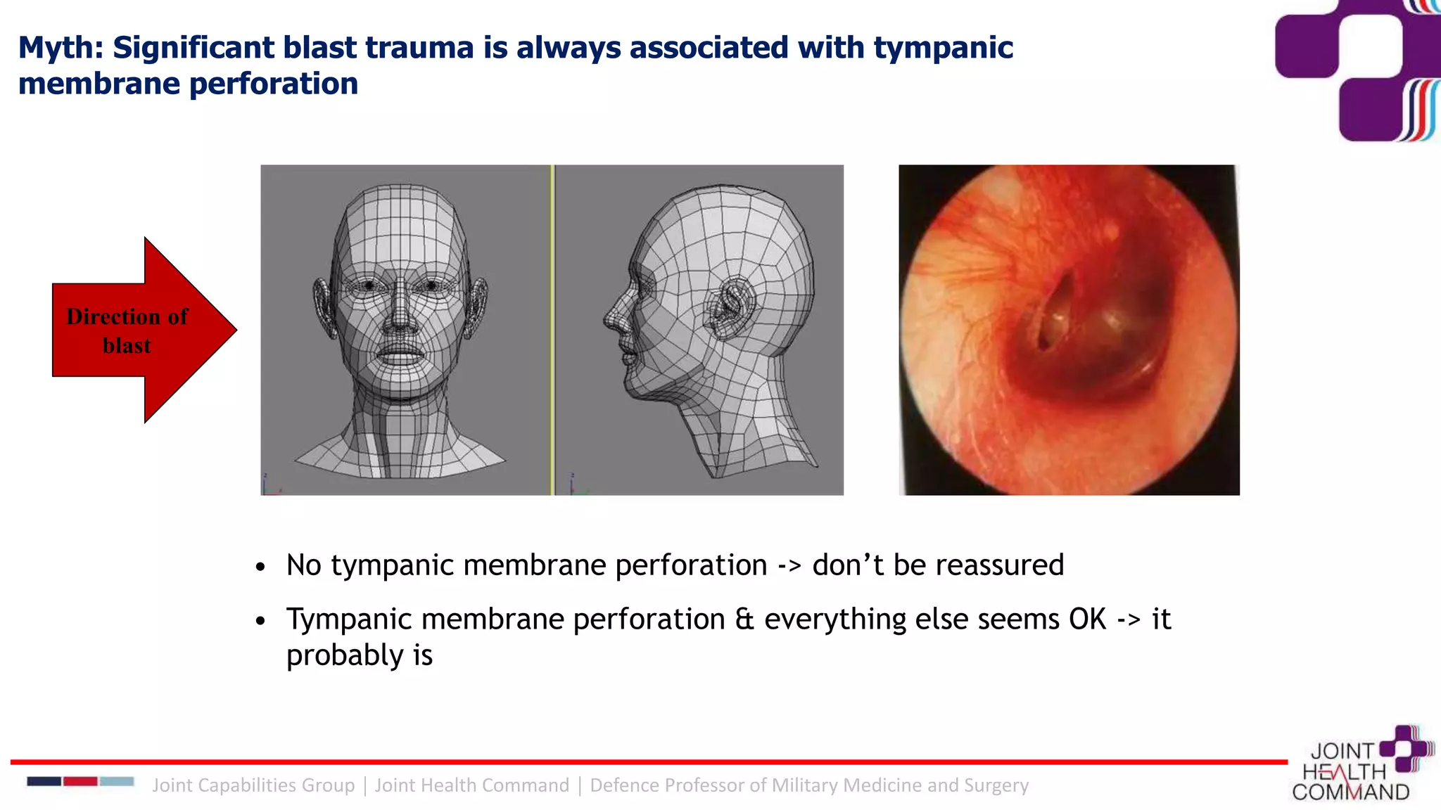 Myth: Significant blast trauma is always associated with tympanic
membrane perforation
• No tympanic membrane perforation -> don’t be reassured
• Tympanic membrane perforation & everything else seems OK -> it
probably is
Direction of
blast
Joint Capabilities Group │ Joint Health Command │ Defence Professor of Military Medicine and Surgery
 