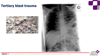 Tertiary blast trauma
Joint Capabilities Group │ Joint Health Command │ Defence Professor of Military Medicine and Surgery
 