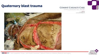 Quaternary blast trauma
Joint Capabilities Group │ Joint Health Command │ Defence Professor of Military Medicine and Surgery
 