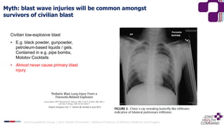 Myth: blast wave injuries will be common amongst
survivors of civilian blast
Civilian low-explosive blast
• E.g. black powder, gunpowder,
petroleum-based liquids / gels.
Contained in e.g. pipe bombs,
Molotov Cocktails
• Almost never cause primary blast
injury
Joint Capabilities Group │ Joint Health Command │ Defence Professor of Military Medicine and Surgery
 