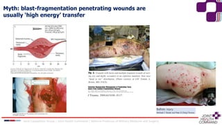 Myth: blast-fragmentation penetrating wounds are
usually ‘high energy’ transfer
Joint Capabilities Group │ Joint Health Command │ Defence Professor of Military Medicine and Surgery
 