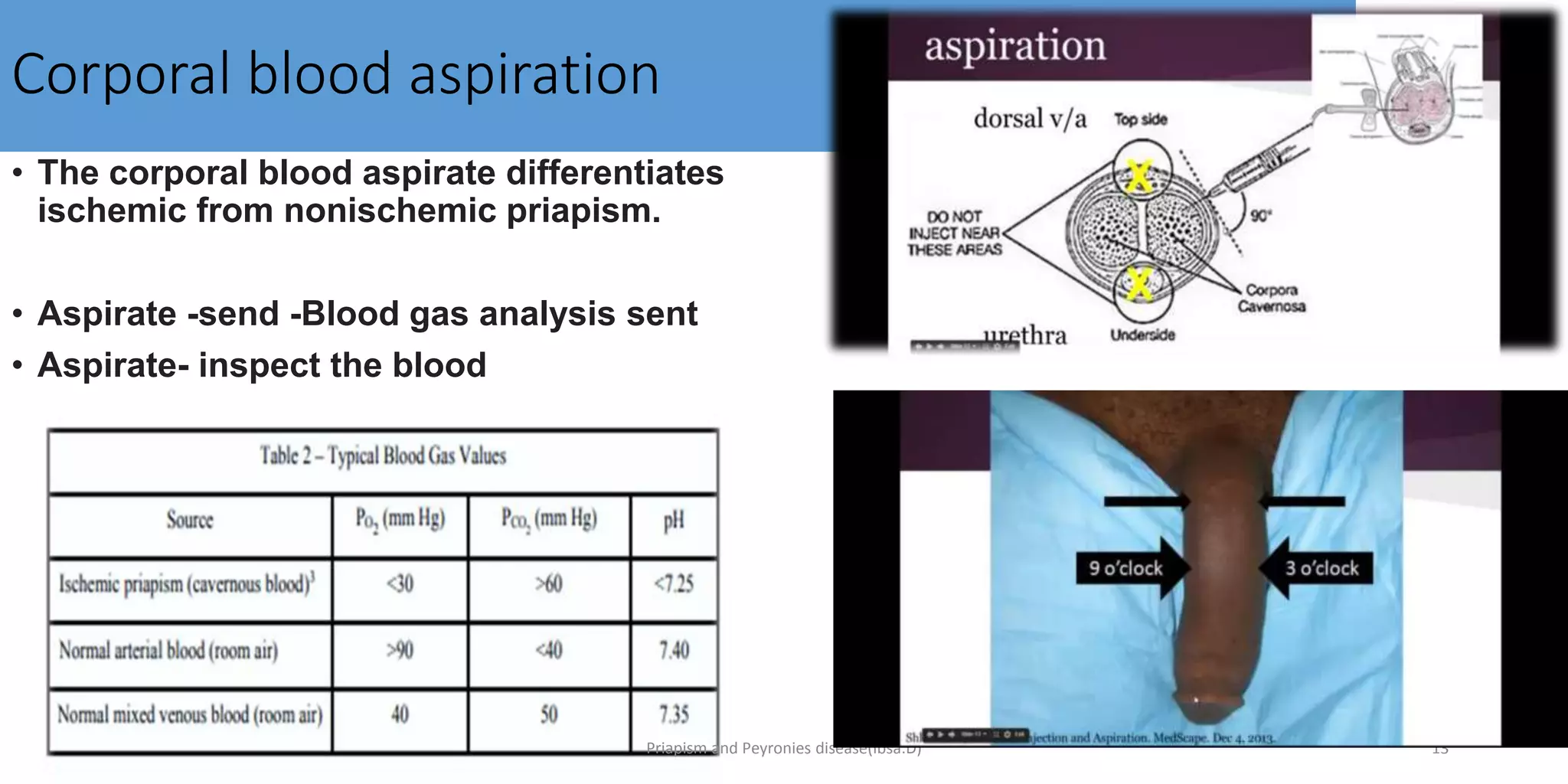 priapism and peyronies disease.pptx
