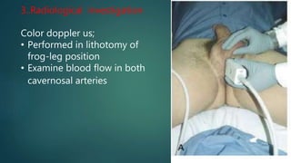 3..Radiological investigation
Color doppler us;
• Performed in lithotomy of
frog-leg position
• Examine blood flow in both
cavernosal arteries
 