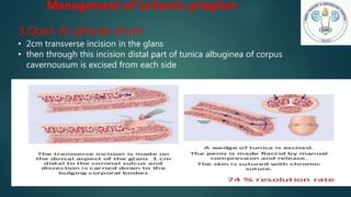 3.Open Al-ghorab shunt
• 2cm transverse incision in the glans
• then through this incision distal part of tunica albuginea of corpus
cavernousum is excised from each side
Management of ischemic priapism
 