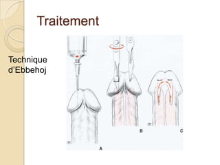 TraitementTraitements á visée étiologique +++ Drépanocytaires, traitement médical spécifiqueoxygène nasal, antalgiques (Paracétamol, AINS …)une hyperhydratation une alcalinisation.Echanges transfusionnels