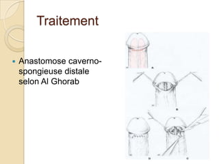 TraitementTraitement chirurgicalDrainage ++système à haute pression (corps caverneux) vers système à basse pression (corps spongieux ou système veineux périphérique) Doit être pratiqué en dernier recours 