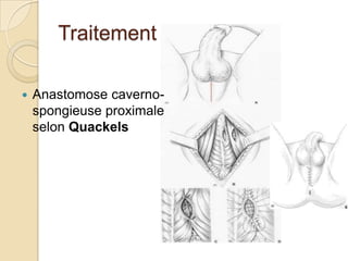 TraitementLa technique de Winter : bloc pénienPonction aspiration corps caverneux+/- irrigation au sérum saléProduit d’aspiration rouge  aiguille retirée et aiguille Tru-Cut introduite.« Biopsies » multiples à l’aveugle