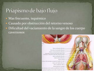  Mas frecuente, isquémico
 Causado por obstrucción del retorno venoso
 Dificultad del vaciamiento de la sangre de los cuerpo
 cavernosos
 