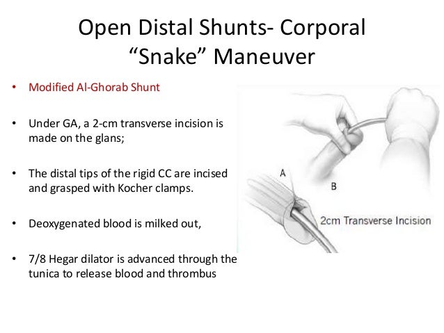 priapism home treatment