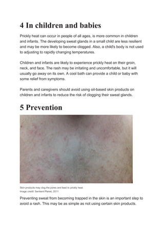 4 In children and babies
Prickly heat can occur in people of all ages, is more common in children
and infants. The developing sweat glands in a small child are less resilient
and may be more likely to become clogged. Also, a child's body is not used
to adjusting to rapidly changing temperatures.
Children and infants are likely to experience prickly heat on their groin,
neck, and face. The rash may be irritating and uncomfortable, but it will
usually go away on its own. A cool bath can provide a child or baby with
some relief from symptoms.
Parents and caregivers should avoid using oil-based skin products on
children and infants to reduce the risk of clogging their sweat glands.
5 Prevention
Skin products may clog the pores and lead to prickly heat.
Image credit: Sentient Planet, 2011
Preventing sweat from becoming trapped in the skin is an important step to
avoid a rash. This may be as simple as not using certain skin products.
 