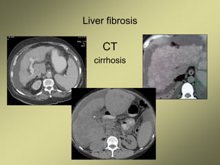 Liver fibrosis
CT
cirrhosis
 