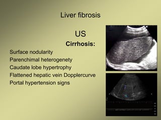 Liver fibrosis
US
Cirrhosis:
Surface nodularity
Parenchimal heterogenety
Caudate lobe hypertrophy
Flattened hepatic vein Dopplercurve
Portal hypertension signs
 