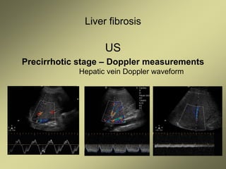 Liver fibrosis
US
Precirrhotic stage – Doppler measurements
Hepatic vein Doppler waveform
 