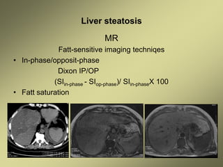 Liver steatosis
MR
Fatt-sensitive imaging techniqes
• In-phase/opposit-phase
Dixon IP/OP
(SIin-phase - SIop-phase)/ SIin-phaseX 100
• Fatt saturation
 