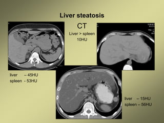 Liver steatosis
CT
Liver > spleen
10HU
liver – 45HU
spleen - 53HU
liver – 15HU
spleen – 56HU
 