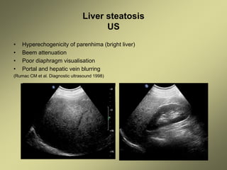 Liver steatosis
US
• Hyperechogenicity of parenhima (bright liver)
• Beem attenuation
• Poor diaphragm visualisation
• Portal and hepatic vein blurring
(Rumac CM et al. Diagnostic ultrasound 1998)
 