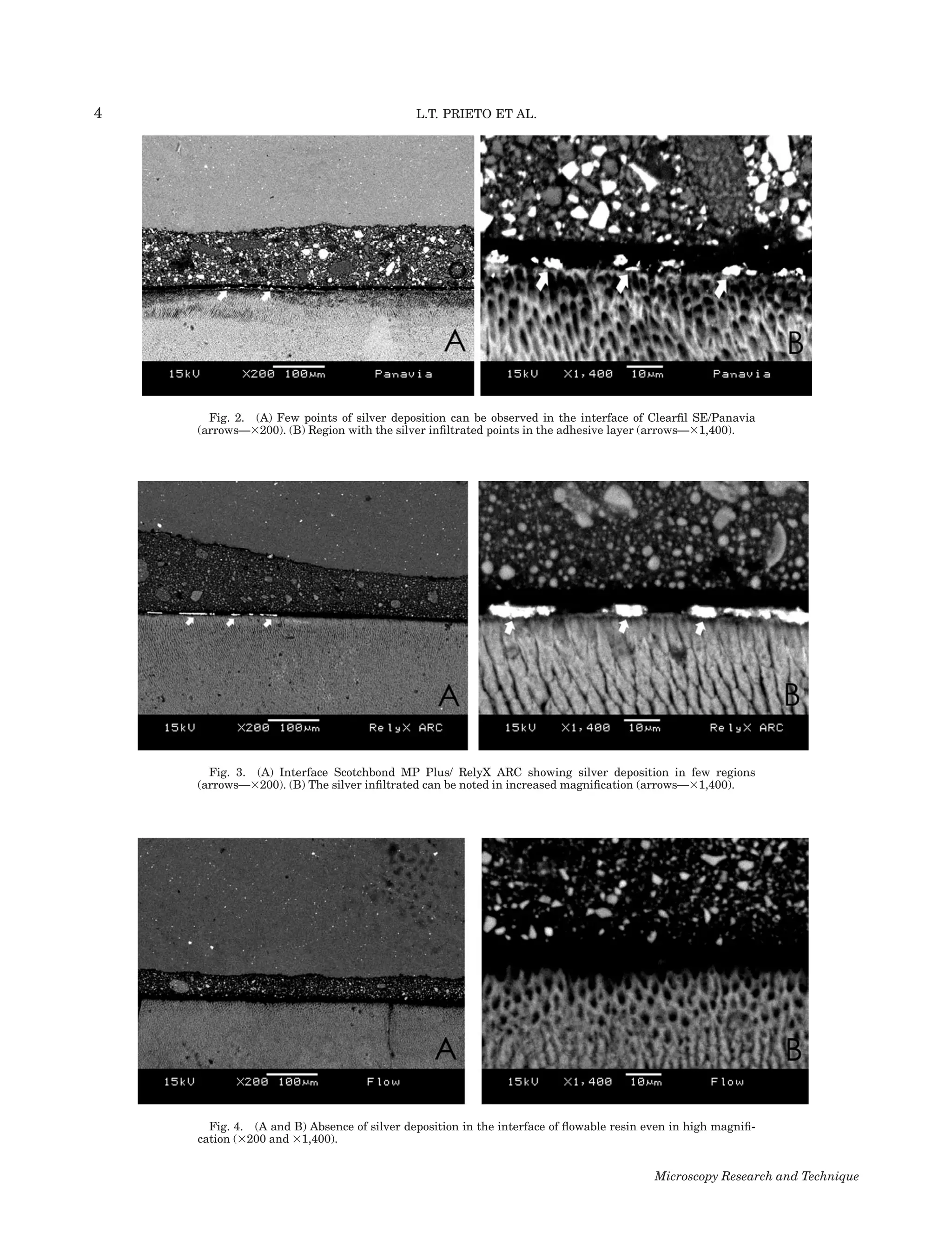 4                                           L.T. PRIETO ET AL.




      Fig. 2. (A) Few points of silver deposition can be observed in the interface of Clearﬁl SE/Panavia
    (arrows—3200). (B) Region with the silver inﬁltrated points in the adhesive layer (arrows—31,400).




      Fig. 3. (A) Interface Scotchbond MP Plus/ RelyX ARC showing silver deposition in few regions
    (arrows—3200). (B) The silver inﬁltrated can be noted in increased magniﬁcation (arrows—31,400).




      Fig. 4. (A and B) Absence of silver deposition in the interface of ﬂowable resin even in high magniﬁ-
    cation (3200 and 31,400).


                                                                                        Microscopy Research and Technique
 