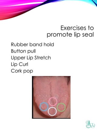 Exercises to
promote lip seal
Rubber band hold
Button pull
Upper Lip Stretch
Lip Curl
Cork pop
 