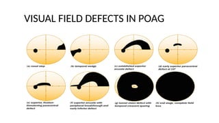 primary-open-angle-glaucoma-ppt guide.pptx