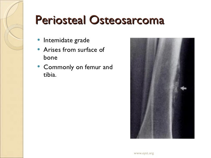 Primary Tumors Of Bone