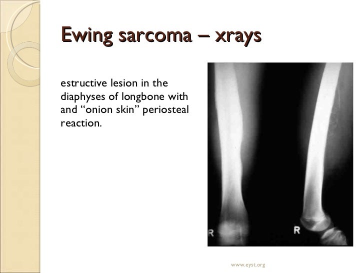 Primary Tumors Of Bone