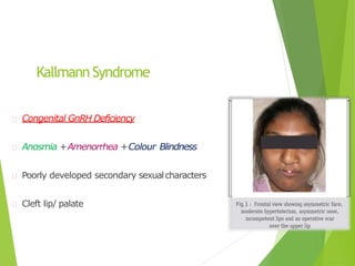 Kallmann Syndrome
Congenital GnRH Deficiency
Anosmia +Amenorrhea +Colour Blindness
Poorly developed secondary sexualcharacters
Cleft lip/ palate
 