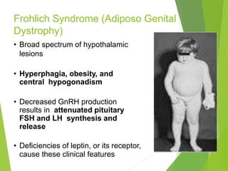 Frohlich Syndrome (Adiposo Genital
Dystrophy)
• Broad spectrum of hypothalamic
lesions
• Hyperphagia, obesity, and
central hypogonadism
• Decreased GnRH production
results in attenuated pituitary
FSH and LH synthesis and
release
• Deficiencies of leptin, or its receptor,
cause these clinical features
 