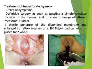Treatment of imperforate hymen-
-Relief of symptoms
-Definitive surgery as soon as possible-a simple cruciate
incision in the hymen and to allow drainage of altered
menstrual fluid or
a sterile puncture of the distended membrane and
enlarged to allow insetion of a 16F Foley’s cathter which is
placed for2 weeks.
 