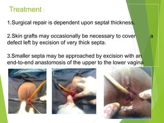 Treatment :
1.Surgical repair is dependent upon septal thickness.
2.Skin grafts may occasionally be necessary to cover a
defect left by excision of very thick septa.
3.Smaller septa may be approached by excision with an
end-to-end anastomosis of the upper to the lower vagina
 