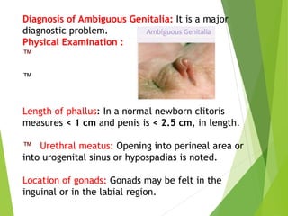 Diagnosis of Ambiguous Genitalia: It is a major
diagnostic problem.
Physical Examination :
™
™
Length of phallus: In a normal newborn clitoris
measures < 1 cm and penis is < 2.5 cm, in length.
™ Urethral meatus: Opening into perineal area or
into urogenital sinus or hypospadias is noted.
Location of gonads: Gonads may be felt in the
inguinal or in the labial region.
 
