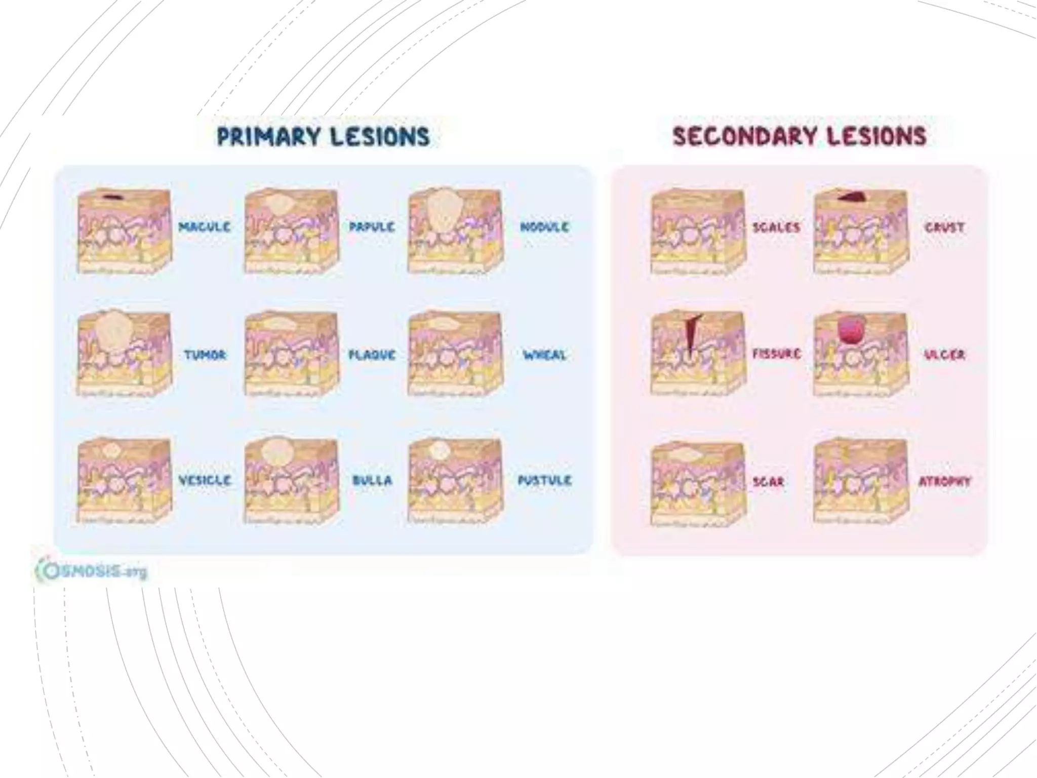Primary and secondary lesions ( oral medicine) | PPTX