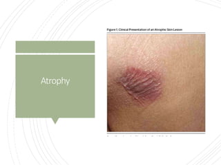 Primary and secondary lesions ( oral medicine) | PPTX