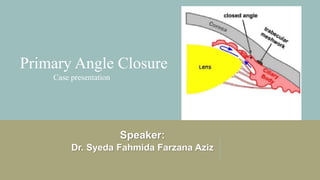 Primary Angle Closure
Case presentation
Speaker:
Dr. Syeda Fahmida Farzana Aziz
 