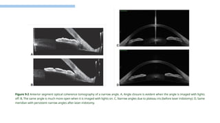 Primary Angle Closure. Primary angle-closure (PAC) disease is a common ...