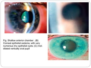 Fig. Shallow anterior chamber . (B)
Corneal epithelial oedema, with very
numerous tiny epithelial cysts; (C) mid-
dilated vertically oval pupil
 